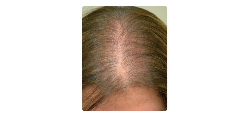 ALOPECIA DIFUSA Conheça os sintomas, as causas e o tratamento