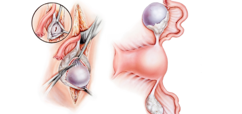 Ooforectomia e Ooforoplastia: causas e tratamentos