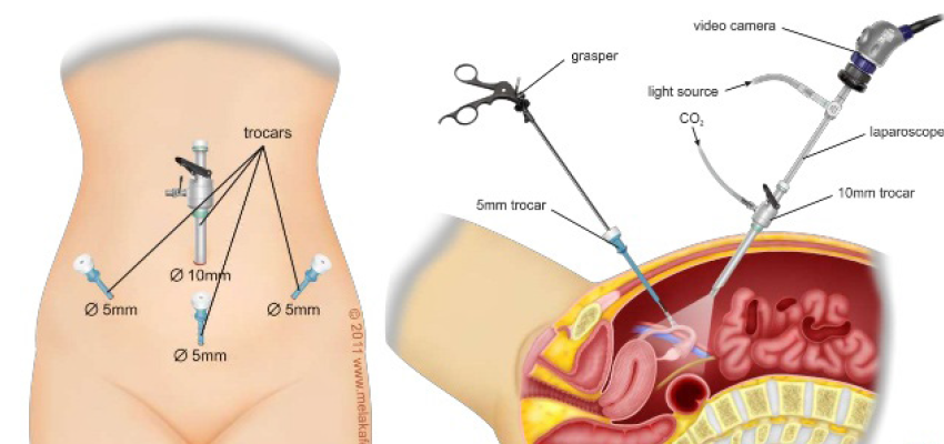 O que é histerectomia e os cuidados da cirurgia