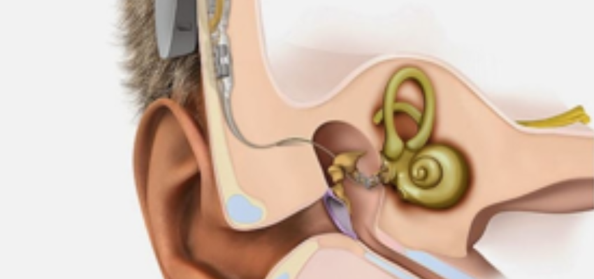 Tipos de implantes auditivos