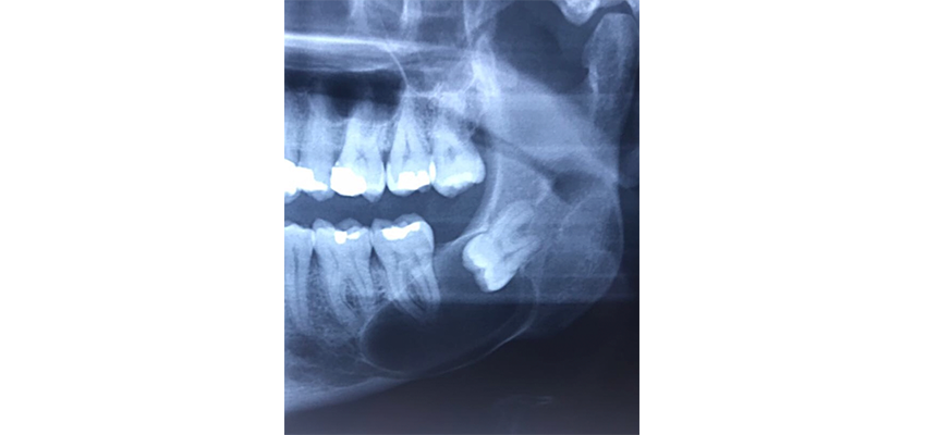 Tratamento dos dentes inclusos e impactados
